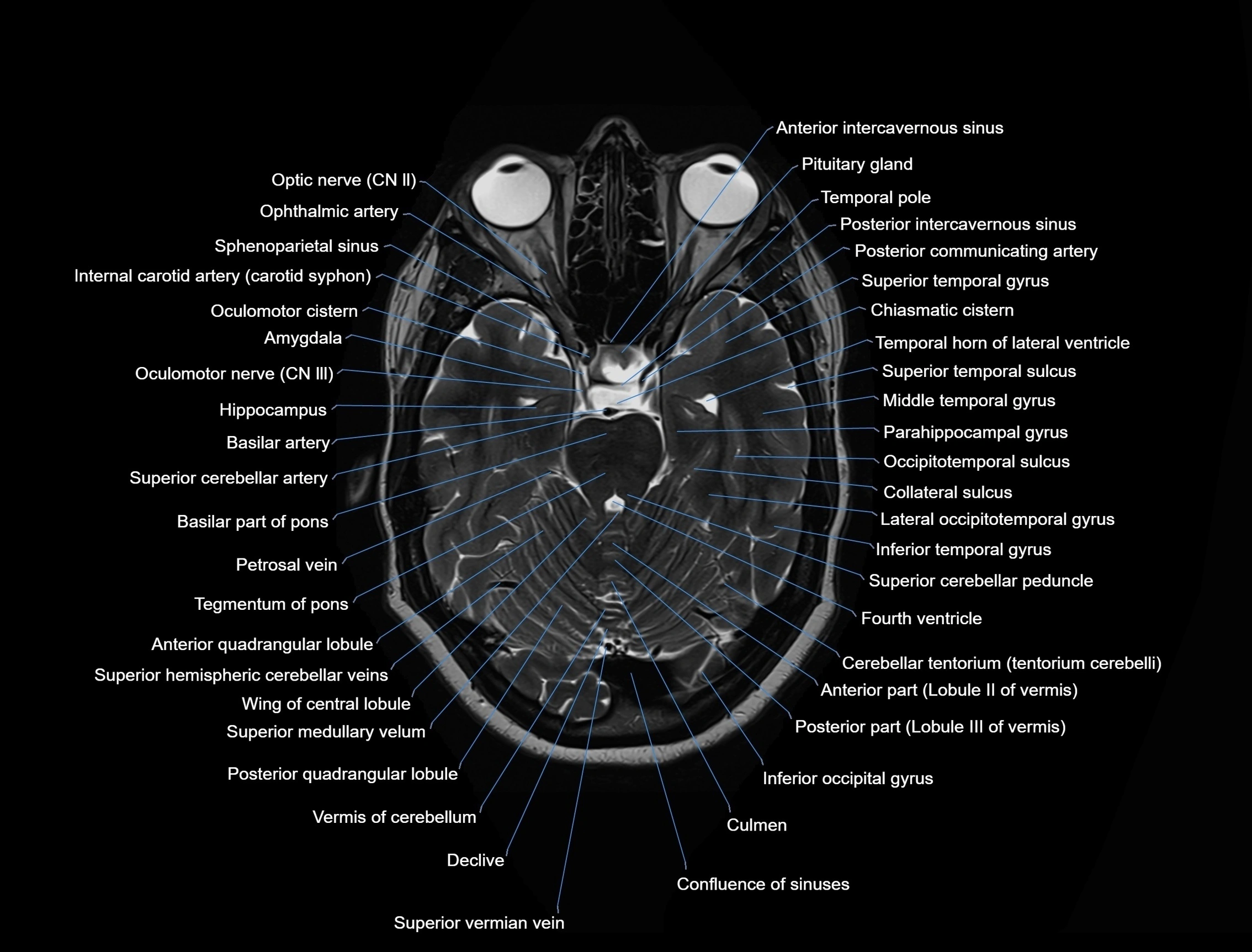 MRI Brain axial cross sectional radiology anatomy 3T image  -img-00001-00019.webp